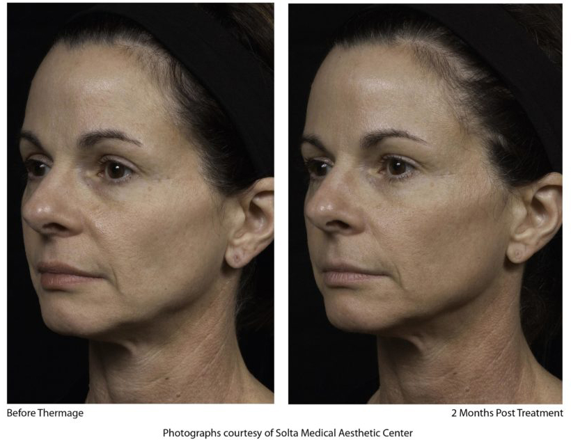 before and after Wheaton skin tightening Thermage treatment