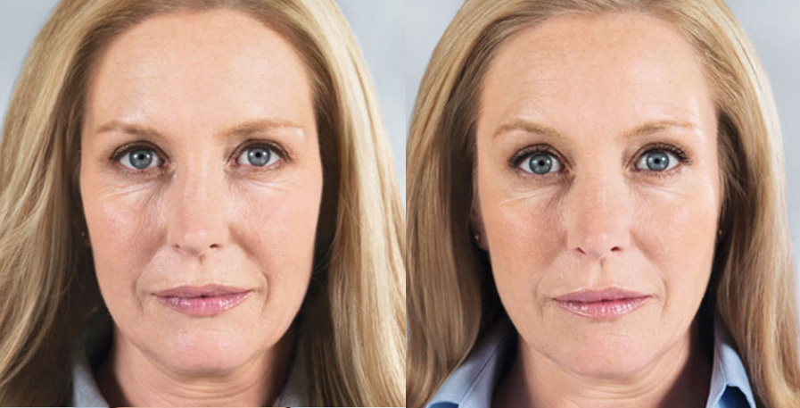 Wheaton sculptra before and after