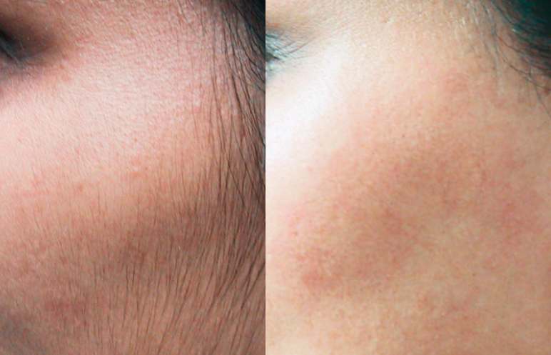 candela laser hair removal before and after 2