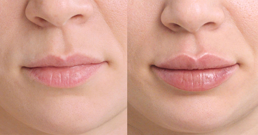 before and after restylane kysse