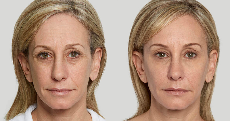 before and after sculptra