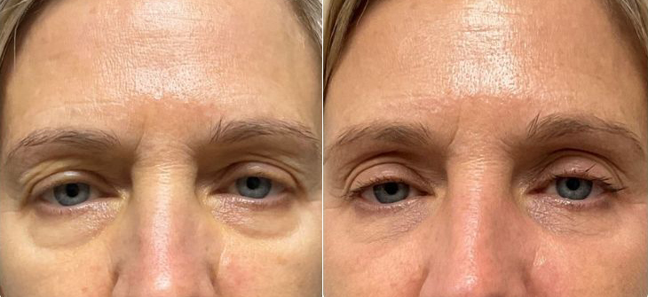 before and after eye tightening