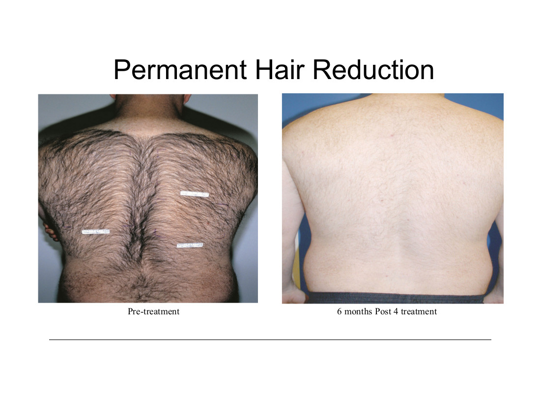 Removal of Unwanted Hair - Radiance Skincare & Laser Medspa - Wheaton, IL