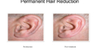 permanent hair removal before and after