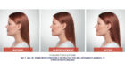 before and after Kybella