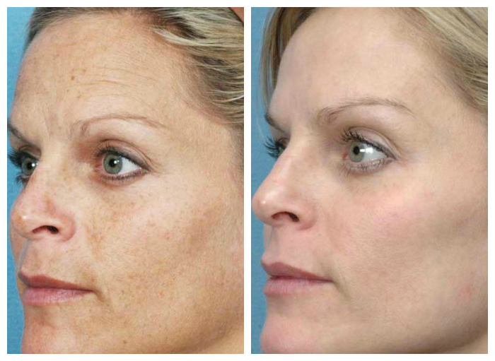Wheaton IPL laser before and after