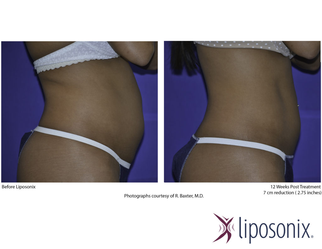 before and after liposonix
