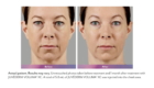 before and after Wheaton Voluma for facial volume