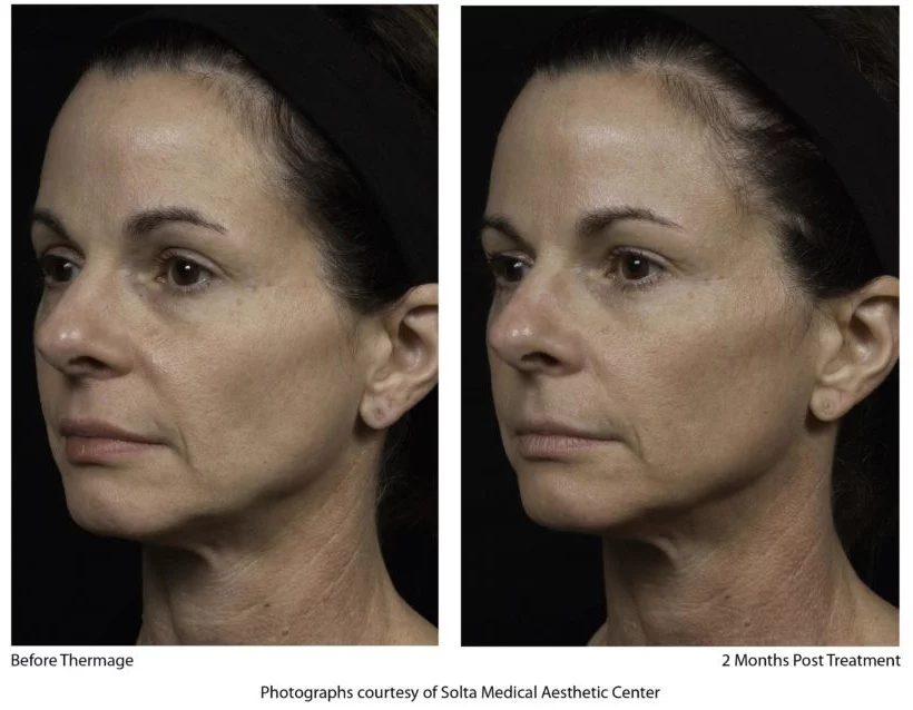 Radiance Wheaton Laser & Medspa Before & After Image