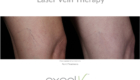Wheaton laser-vein-therapy-before-and-after