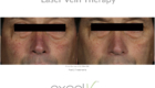 Wheaton laser-vein-therapy-before-and-after