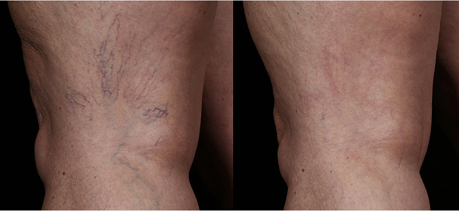 spider veins before and after Wheaton laser vein treatment