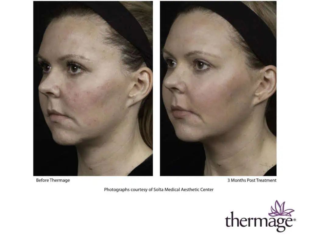 Radiance Wheaton Laser & Medspa Before & After