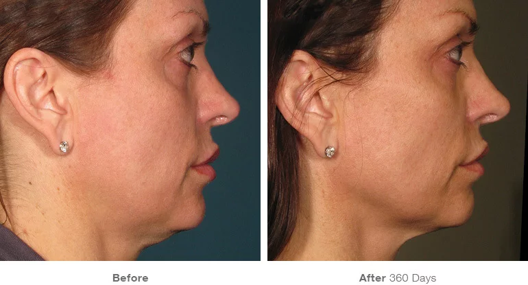 Radiance Wheaton Laser & Medspa Before & After