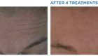 Exilis Ultra before and after
