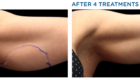 Exilis Ultra before and after