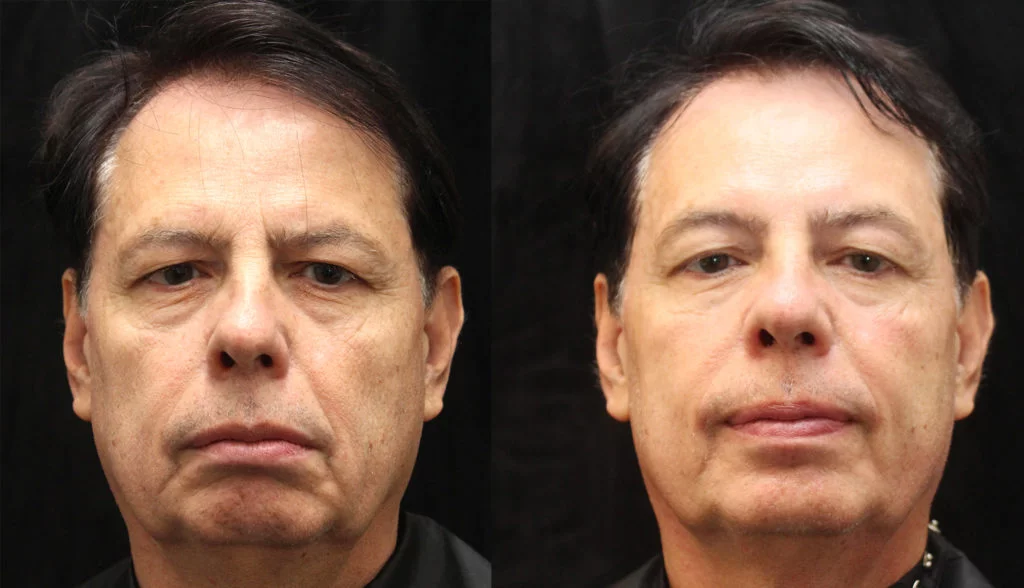 btl skin tightening wheaton