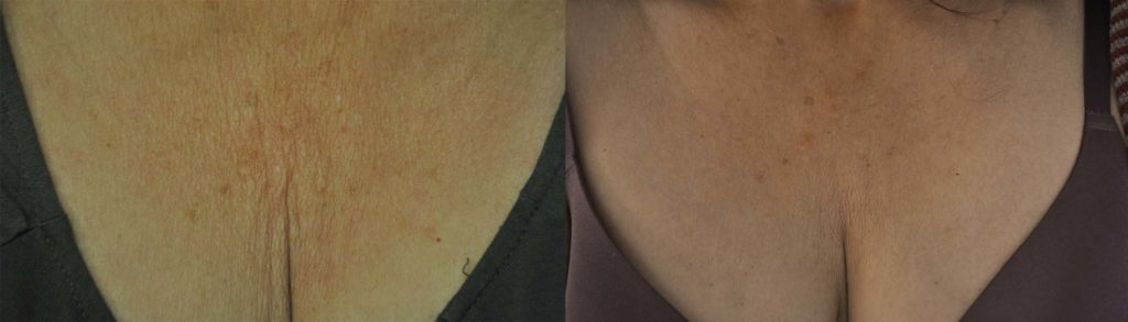before and after exilis ultra 7before and after exilis ultra