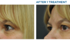 exilis ultra before and after eyes