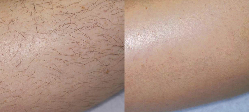 before and after leg laser hair removal