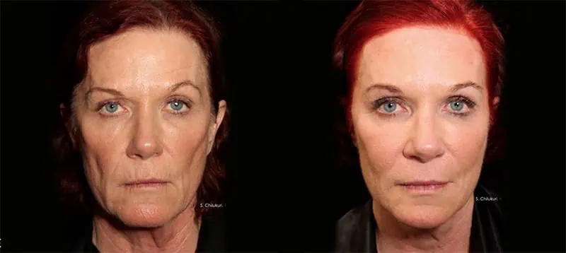 Radiance Wheaton Laser & Medspa Blog