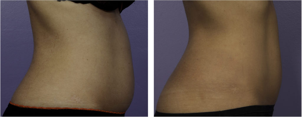 Wheaton liposonix before and after