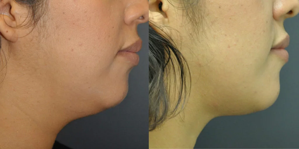 exilis ultra double chin