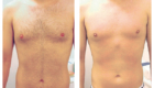 before and after Wheaton laser hair removal
