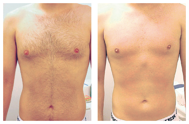 Removal of Unwanted Hair - Radiance Skincare & Laser Medspa - Wheaton, IL