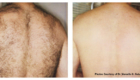 before and after Wheaton laser hair removal