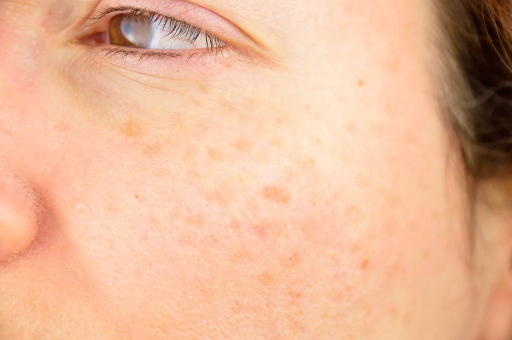 Radiance Wheaton Laser & Medspa Blog