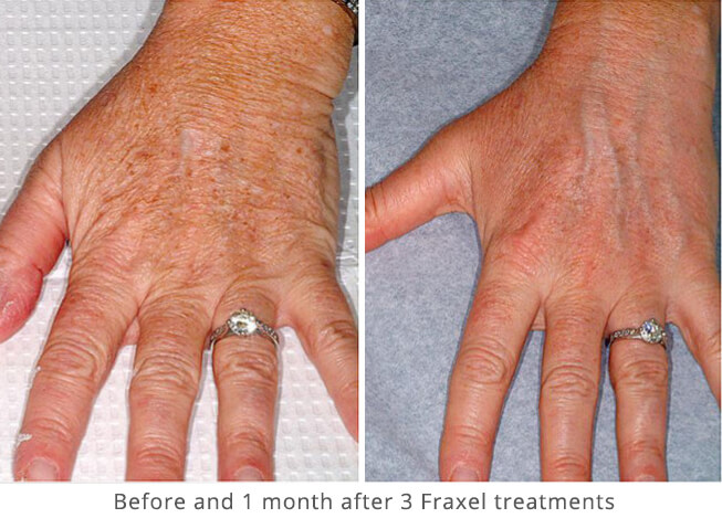 before and after fraxel for hands