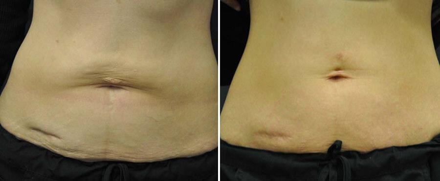 exilis ultra before and after