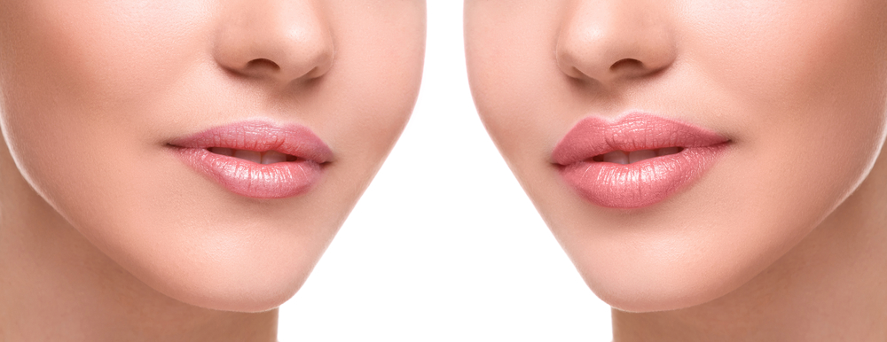Switch lip filler to restylane kysse