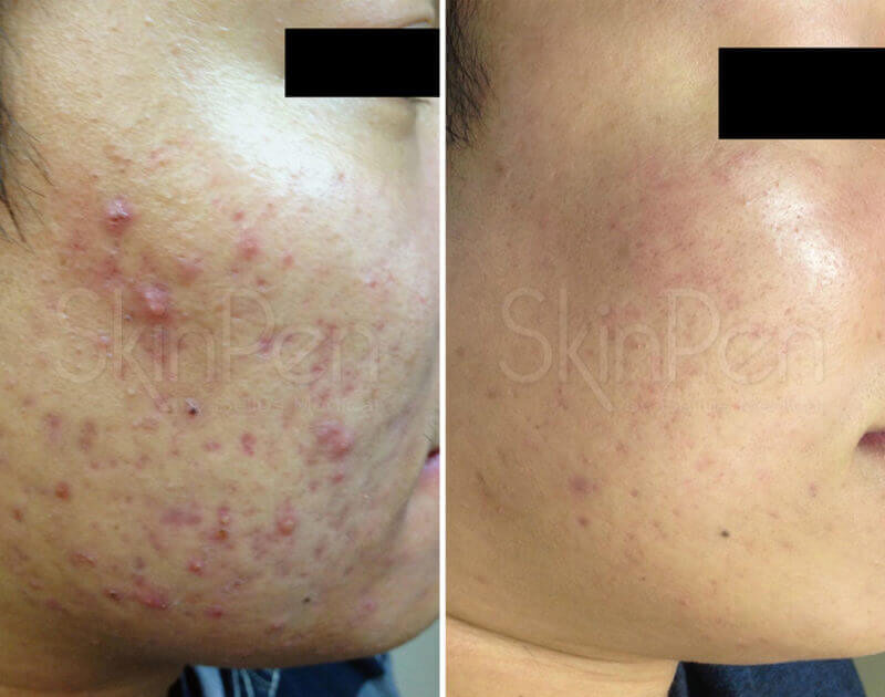 before and after skinpen microneedling
