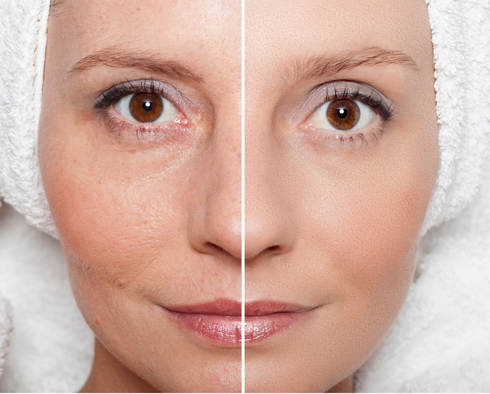 Non-surgical skin tightening treatments that work