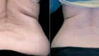 before and after exilis ultra back
