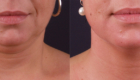 before and after exilis ultra chin
