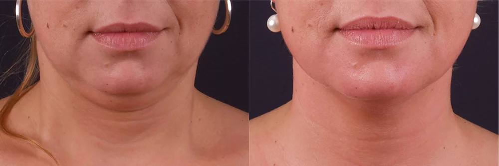 before and after exilis ultra chin
