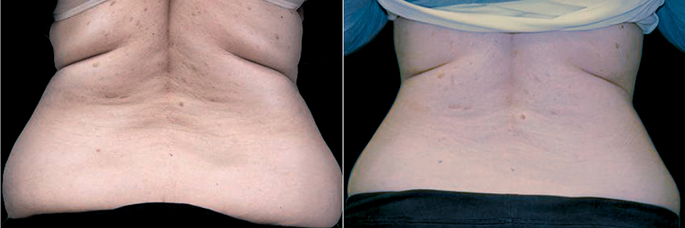 before and after exilis ultra back