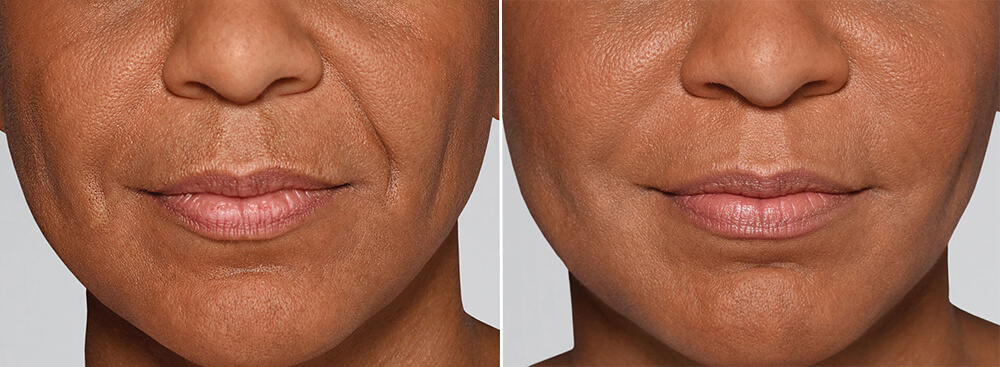 before and after restylane refyne