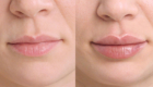 before and after restylane kysse