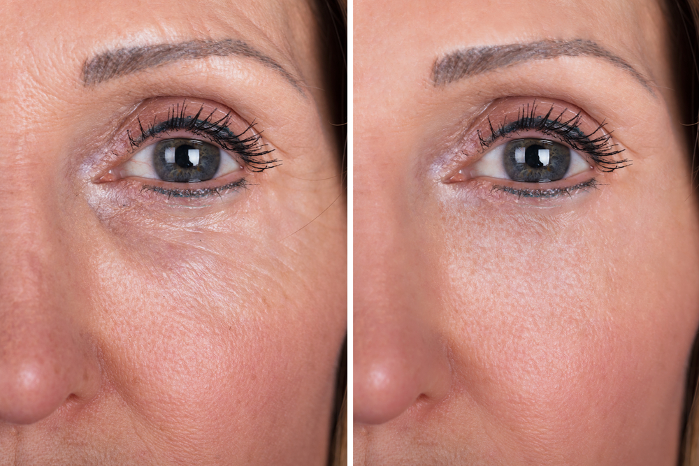 Ultherapy under eye treatment