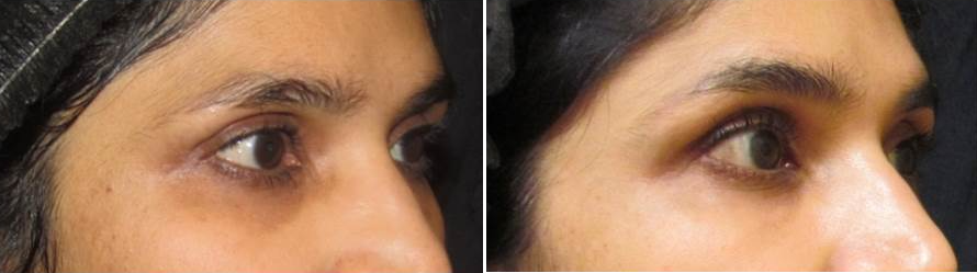 before and after ultherapy and belotero