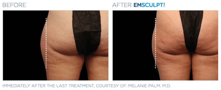 before and after emsculpt neo