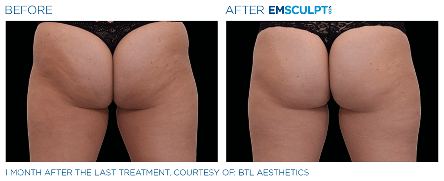 before and after emsculpt neo