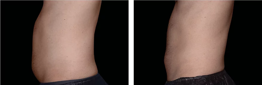 before and after emsculpt neo