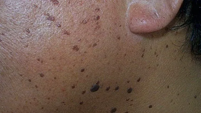 DPN dermatosis papulosa nigra