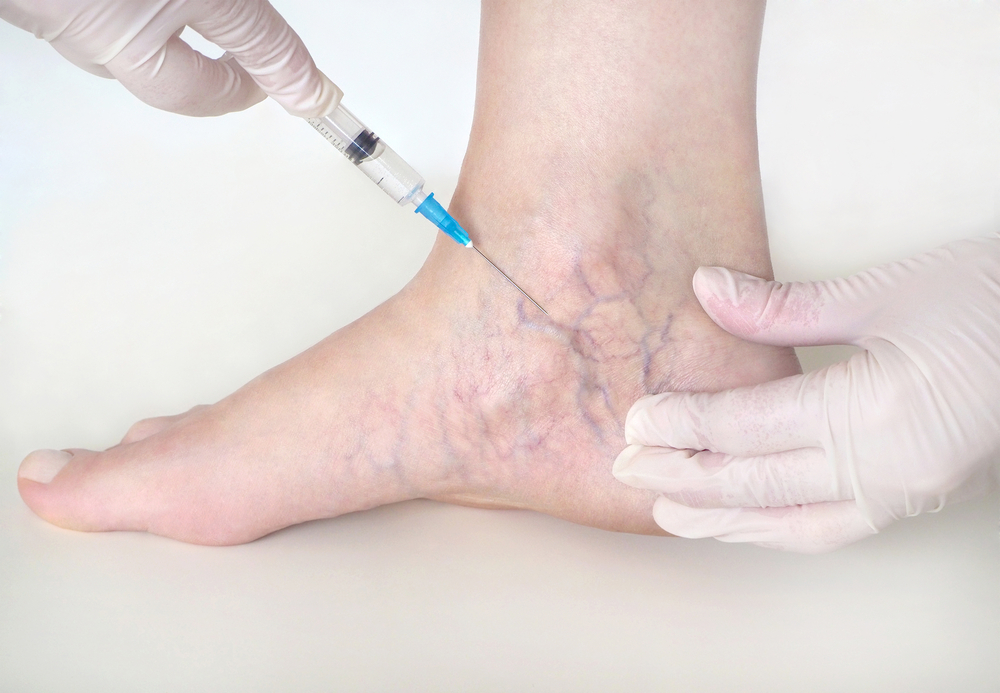 woman receiving sclerotherapy injections
