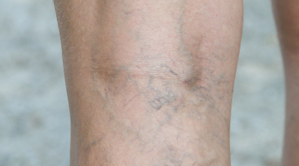 spider veins on a woman's leg